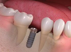 Dental Implants